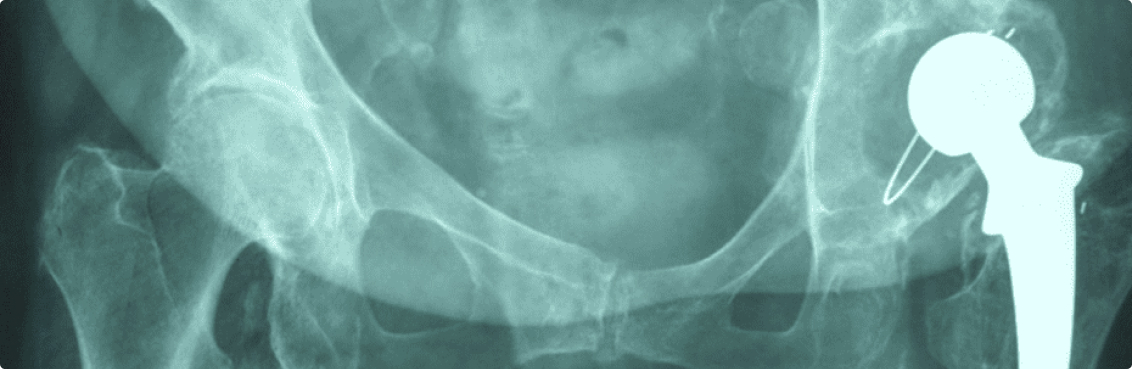 μέθοδος asi για αρθροπλαστική ισχίου