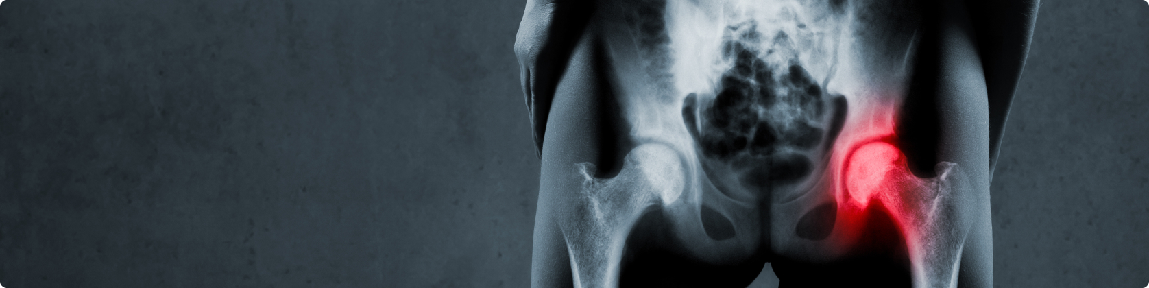 Αρθροπλαστική Ισχίου – Αποκατάσταση