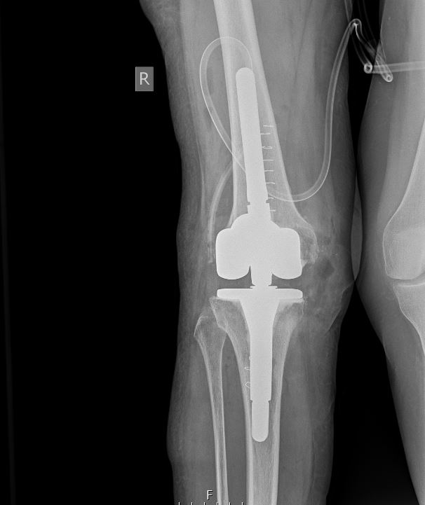 Αναθεώρηση Αρθοπλαστικής Γόνατος