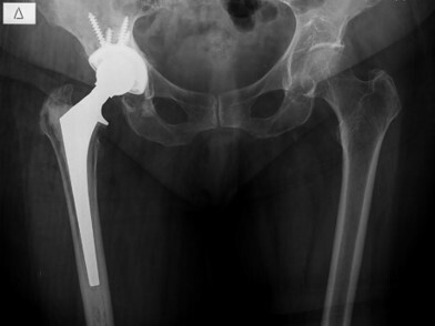 Αναθεώρηση Αρθροπλαστικής Ισχίου