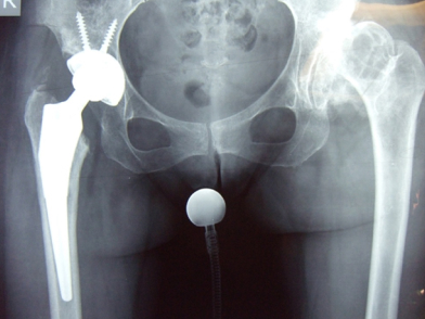 Δυσπλασία ισχίου