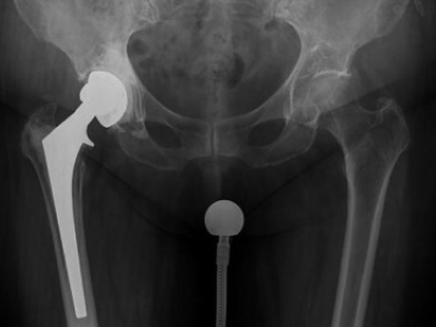 Χαλάρωση Ολικής Αρθοπλαστικής Ισχίου