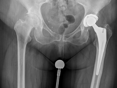 Οστεοαρθρίτιδα Ισχίου