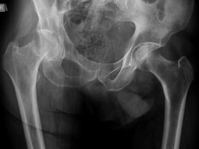 Κάταγμα Ισχίου