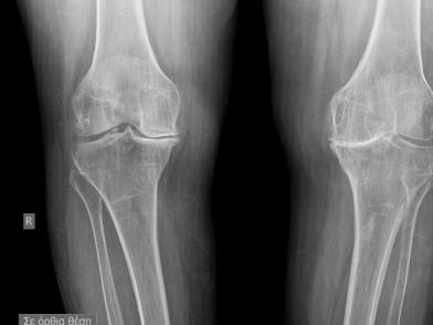 Οστεοαρθρίτιδα Γόνατος