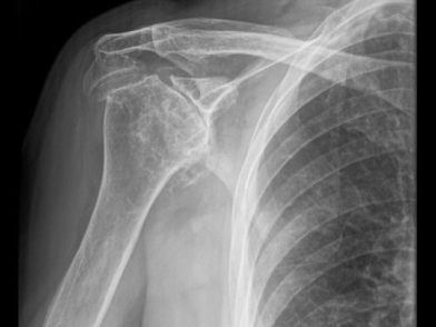 Αρθοπλαστική Ώμου