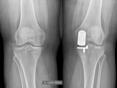 Μονοδιαμερισματική Αρθοπλαστική Γόνατος