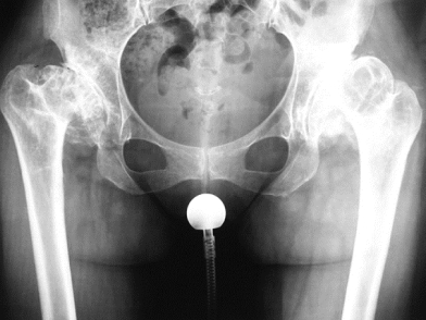 Δυσπλασία ισχίου