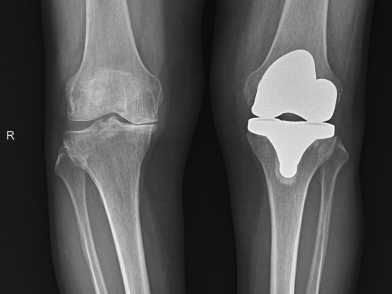Αρθροπλαστική Γόνατος