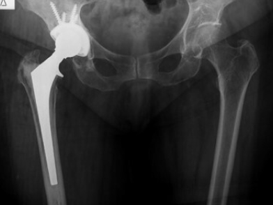 Χαλάρωση Ολικής Αρθοπλαστικής Ισχίου