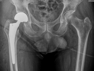 Κάταγμα Ισχίου