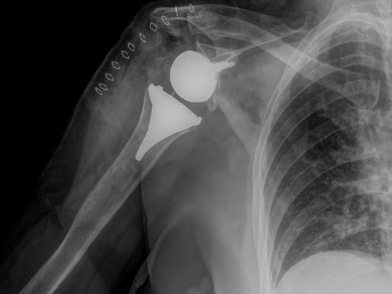 Οστεοαρθρίτιδα Ώμου