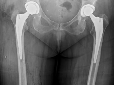 Αρθροπλαστική Ισχίου