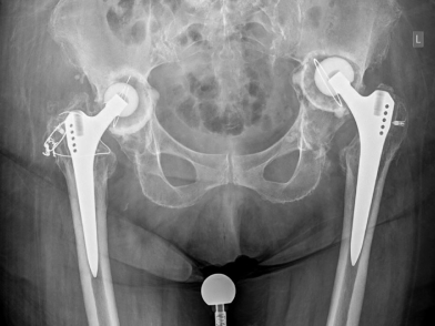 Χαλάρωση Ολικής Αρθοπλαστικής Ισχίου