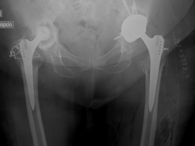 Χαλάρωση Ολικής Αρθοπλαστικής Ισχίου