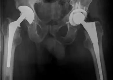 Total Hip Replacement Loosening