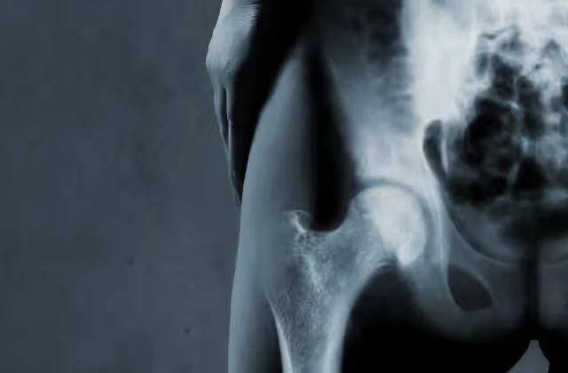 Hip Arthroplasty – ASI Method