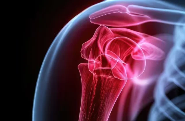 Shoulder Arthroplasty