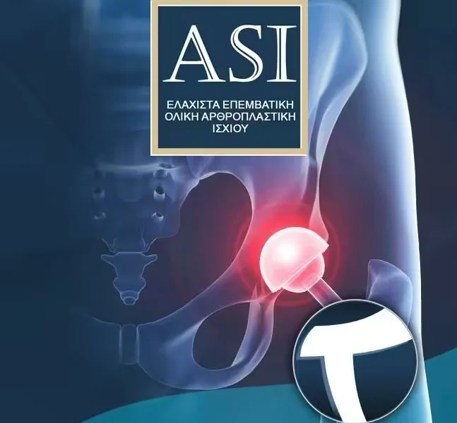Total Hip Replacement with the ASI Method: The Painless and Atraumatic Solution to Osteoarthritis