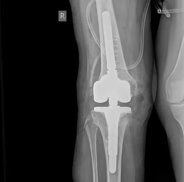 Revision Knee Replacement