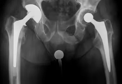 Total Hip Replacement Loosening