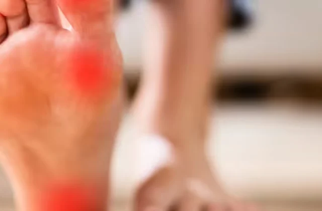 Metatarsalgia (Dropped Metatarsals)